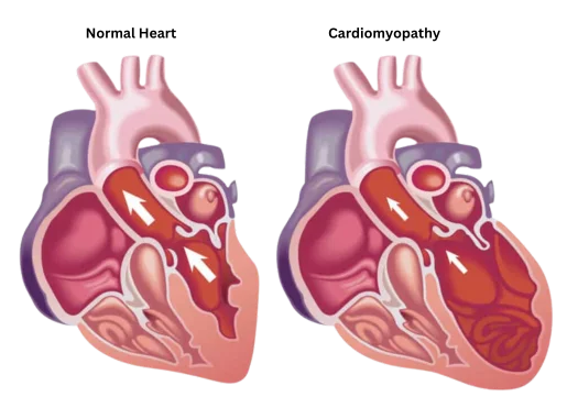 Cardiomyopathy